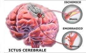 Vascolopatie cerebrali Ictus